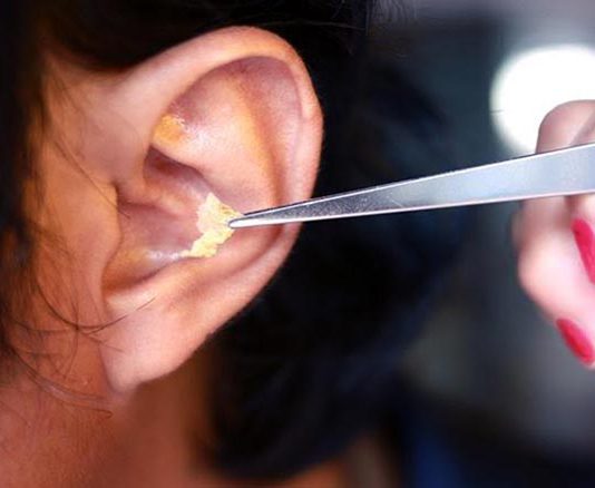 ภาวะ ขี้หูอุดตัน